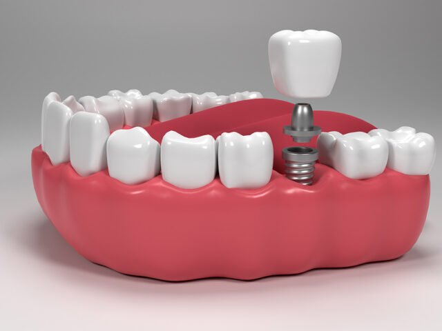 Top Reasons to Choose Istanbul for Dental Implants