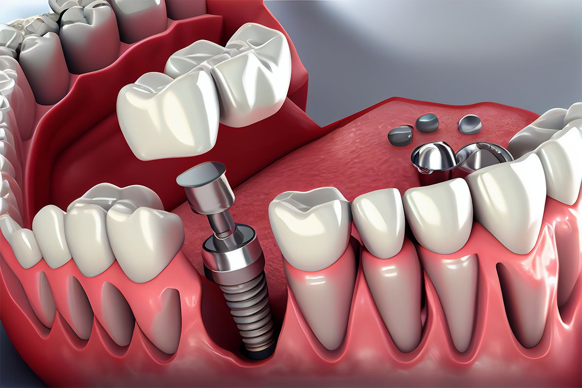 istanbul for dental implants