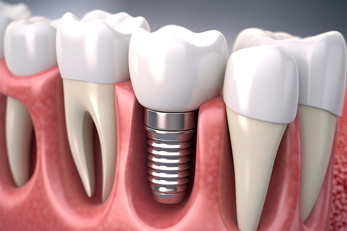 istanbul for dental implants